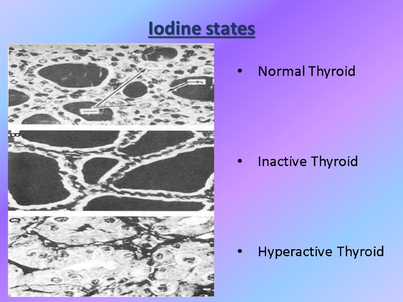 Iodine states Normal Thyroid    Inactive Thyroid    Hyperactive Thyroid